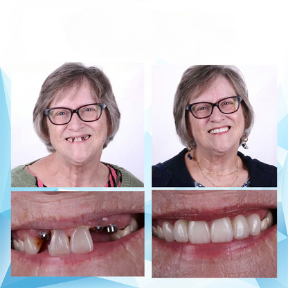 Regulowana Proteza Zębowa Nakładana Dopasowanie Codzienne