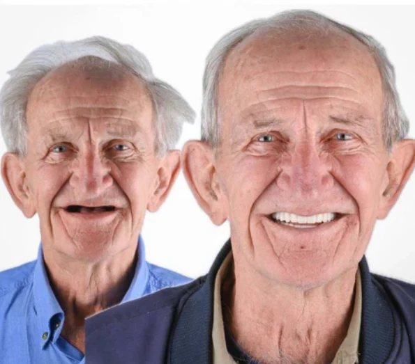 Natural-Looking Dentures Comfort and Confidence Smiling - Image 14
