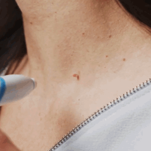 Skin Tag Removal Kit Easy Use Beauty Tool Home Treatment - Image 9